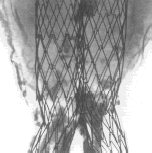 Figure 8. X-rays of the explanted device. The aneurysmal sac is delineated and this illustration confirms the presence of solidified tissues. The benefit of X-rays is mostly the visibility of the structure.
