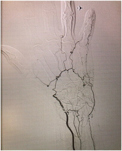 Figure 2. Left hand arteriogram, demonstrating 80% stenosis of the radial artery at the level of the wrist, suggestive of an atheromatous plaque, absence of the DPA, an incomplete SPA at the level of the fourth and fifth digits (collaterals were seen bridging the incomplete superficial arch).