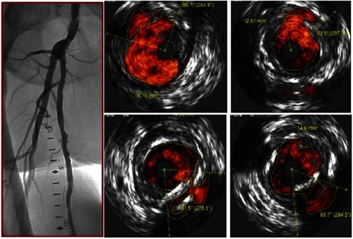 Figure 3 Multiple dissections seen on intravascular ultrasound that are not visible on angiogram.