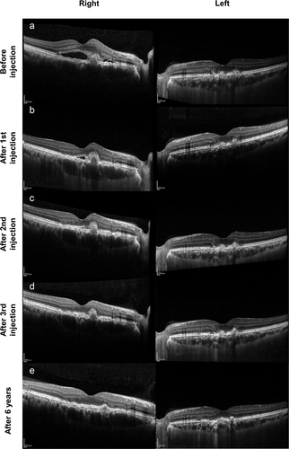 Figure 2. Follow-up of optical coherence tomography (OCT). (a) OCT demonstrated subretinal hyperreflective material with surrounding subretinal fluid in the right eye. In the left eye, OCT showed subretinal juxtafoveal hyperreflective vitelliform lesions corresponding to the yellow flecks, interruption of retinal pigment epithelium (RPE), and small cystoid edema. (b, c, d) OCT followed the changes in the right eye after each intravitreal injection. The left eye remained hyperreflectivity vitelliform lesions. (e) CNV and subretinal fluid in the right eye were completely regressed after 6 years