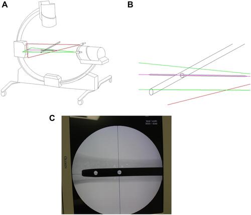 Figure 2 Work principle sketch maps of the new device. Before operation, the device was adjusted repeatedly to ensure that the intersection of the horizontal green-light laser and the coronal red-light laser (A and B), X-ray fluoroscopy center and display screen center were completely overlapped (C).