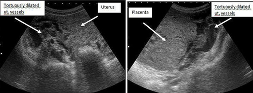Figure 4 Picture shows tortuously dilated uterine vessels suggesting uterine artery is the feeding artery.