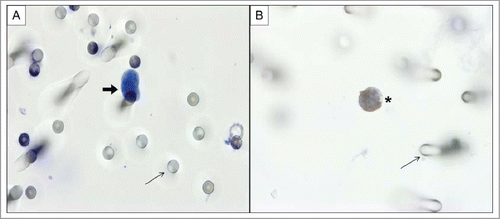 Figure 1. (A) CTC (thick arrow) isolated by ISET from patient with mCRC stained with hematoxylin-eosin. (B) Residual leukocyte (asterisk), without any CTC visualized on the ISET membrane. Spiked cells were stained with antibody against CD45 to identify leukocytes, visualized with DAB (3,3′- Diaminobenzidine) and counterstained with haematoxylin. Images were taken using a light microscope (Axioskop 40; Carl Zeiss Meditec, Jena, Germany) coupled to a digital camera (Sony Cyber-Shot Dsc-s75; Sony, Tokyo, Japan) at 60× magnification. Fine arrows represent pores of ISET membrane.