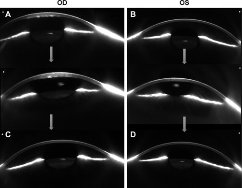 Figure 1 Serial Scheimpflug imaging of amantadine-associated corneal edema. At initial diagnosis, edema was noted to be central in distribution, worse in the right eye (A) than the left (B). After cessation, corneal edema resolved. Despite the necessity of resuming amantadine, the patient has continued to maintain corneal clarity with concurrent steroids, with resolution of edema in both right (C) and left (D) eyes, more than 2 years after initial presentation.