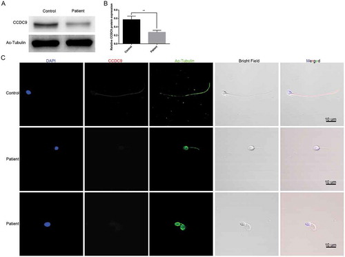 Figure 3. CCDC9 protein level in the patient and normal control. (A) CCDC9 protein level was determined using Western blotting. The expression of CCDC9 protein in the sperm of patient was very weak. (B) The density of bands was quantified using ImageJ. CCDC9 protein decreased significantly in the patient. Acetylated-Tubulin was used as the loading control. The results are expressed as the mean SD of the three independent experiments. Data was analyzed with SPSS 18.0 software. **P < 0.01. (C) CCDC9 protein expression (Red) was determined with immunofluorescence assay. Chromatin was labeled with DAPI (Blue), and sperm tails were labeled with Acetylated Tubulin (Green). The CCDC9 was located along the flagellum in control. However, CCDC9 was nearly undetectable along the flagellum in the sperm of the patient. Multiple images were taken and the representative images were presented. Scale bar: 10 μm. Abbreviations: CCDC9, coiled-coil domain containing 9; DAPI: 4ʹ,6-diamidino-2-phenylindole.