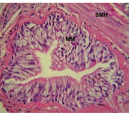 Figure 2 MM and smooth muscle hypertrophy in a small airway from a COPD patient.Note: Hematoxylin and eosin stain.Abbreviations: MM, mucous metaplasia; SMH, smooth muscle hypertrophy; COPD, chronic pulmonary disease.