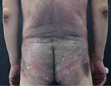 Figure 3 A large, diffuse dark erythema on the back of the buttocks with thickened skin and bright red margins, scales and hyperpigmentation.