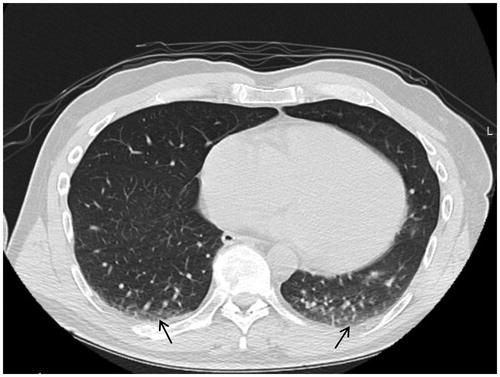 Figure 4. CT scan of one of the study subjects at the end of surgery. The arrows indicate small areas of atelectasis formation. In this case, 1.9% of the total lung area was affected, and this value corresponded to the median of all subjects in the study.