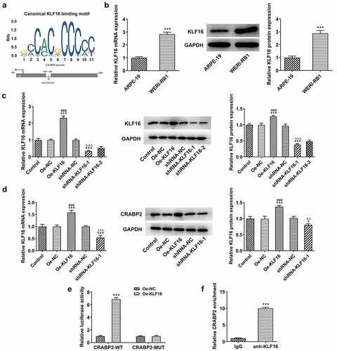 Figure 4. KLF16 positively modulates CRABP2 transcription in RB. (a) The binding sites between KLF16 and CRABP2. (b) KLF16 mRNA and protein expression in WERI-RB1 cells and ARPE-19 cells were respectively detected by RT-qPCR analysis and Western blot. ***P < 0.001 vs. ARPE group. (c) KLF16 mRNA and protein expression in WERI-RB1 transfected with Oe-KLF16 or sh-KLF16-1/2 were respectively detected by RT-qPCR analysis and Western blot. (d) CRABP2 mRNA and protein expression in WERI-RB1 transfected with Oe-KLF16 or sh-KLF16-1 were respectively detected by RT-qPCR analysis and Western blot. *P < 0.05 and ***P < 0.001 vs. control group. ###P < 0.001 vs. Oe-NC group. ∆∆P < 0.01 and ∆∆∆P < 0.001 vs. shRNA-NC group. (e) The interaction between KLF16 and CRABP2 was analyzed by dual-luciferase reporter assay. ***P < 0.001 vs. Oe-NC group. (f) The binding ability of KLF16 to CRABP2 promoter was detected by ChIP. ***P < 0.001 vs. IgG group.