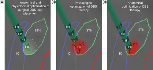 Figure 2. Optimization of left subthalamic deep brain stimulation therapy for the same patient with Parkinson’s disease described in Figure 1. (A) During surgical implantation of the left STN DBS lead, microelectrode recordings and stimulation defined a physiologically optimized trajectory and target in the dorsolateral region of the anatomically defined left STN. (B) During the initial programming session described in Figure 1, contact E0 was chosen to deliver DBS to the region with the highest peak of low beta LFPs. Upon subsequent DBS amplitude increase, the patient developed subtle side effects due to lateral spread of stimulation toward the IC, which limited the benefits of DBS. (C) With directional stimulation using segmented leads, this lateral spread of stimulation could be theoretically avoided and DBS therapy could be further optimized. Reconstruction of neuroanatomical structures and DBS lead localization were performed by merging pre-operative brain MRI and post-operative CT using BrainLab.CT: Computed tomography; DBS: Deep brain stimulation; IC: Internal capsule; LFP: Local field potential; STN: Subthalamic nucleus.