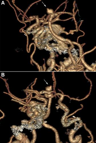 Figure 2 Ruptured basilar tip aneurysm. 3D CT angiography, (A) frontal and (B) lateral projections, shows a unilocular saccular aneurysm arising from the basilar tip (arrows) with a daughter sac at the left side of the aneurysm dome. The aneurysm is slightly inclined anteriorly. There is also an incidental finding of bilateral carotid cavernous fistulae.