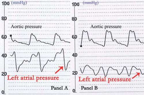 Figure 2. The mean left atrium pressure dropped significantly before (Panel A) and after (Panel B) the atrial septostomy.
