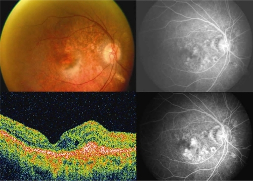 Figure 1 Case 1: Color fundus photograph of the right eye (upper left) shows a grayish-brown subfoveal lesion suggestive of choroidal neovascular membrane. Early hyperfluoresence with intense late staining on fundus fluorescein angiography confirms the presence of predominantly classic choroidal neovascularization (upper right and lower right). Optical coherence tomography scan reveals the presence of a high reflective, spindle-shaped lesion abutting the fovea with increased overlying retinal thickness and intraretinal cystoid spaces (lower left).