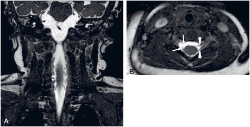 Figure 1. Coronal (A) and axial (B) BFFE MR images (0.5 mm) in a 3-month-old boy (patient 18) with brachial plexus birth injury on the right side. Total (both ventral and dorsal roots) avulsion of right C6 root with a PMC (asterisk): ventral root is avulsed from the cord (upper arrow), where a short stump of dorsal root is seen (lower arrow). Left ventral and dorsal C6 roots (arrowheads) are normal.