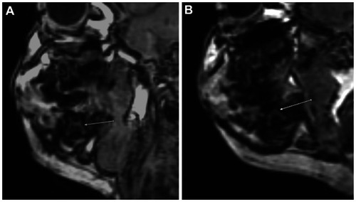 Figure 7 Sagittal FSPGR BRAVO image through the right mandible of our patient and a normal child. (A) Sagittal FSPGR BRAVO image through the right mandible of our patient showing evidence of a second deciduous mandibular molar taurodontia manifested by enlarged pulp chamber-to-root ratio (arrow). (B) Sagittal FSPGR BRAVO image through the right mandible of a 19-month-old normal child showing a normal second deciduous mandibular molar for comparison (arrow).