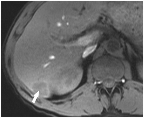 Figure 2. A hypovascular metastatic lesion in the liver. Liver MRI TI W image on post-contrast arterial phase showing a hypo-intense lesion with subtle concentric perilesional enhancement in segment VI of the liver (arrow).