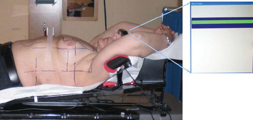 Figure 1. The patient was positioned in a standard breast immobilization device. The marker box was placed on the chest. With the RPM™-system the breathing position is visible for the patient as a yellow line on the binocular head mounted display. When the line is within the gating window (blue) the color turns green and the CT scan can be acquired or irradiation delivered on the accelerator.