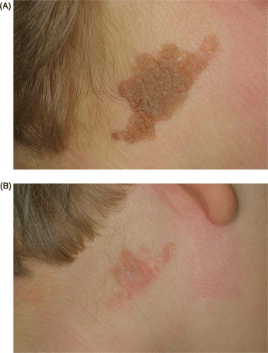 Figure 1. (A) Epidermal nevus in the cervical region of an 11-year-old boy. (B) Result after three sessions of CO2 laser (cw mode), 10 W of power, 2 mm spot size.