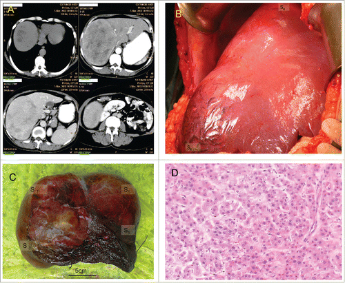 Figure 1. Giant hepatic adenoma of the sister. (A) CT scan; clockwise from upper-left: Unenhanced scan, arterial phase of contrast enhanced scan, delayed phase of contrast enhanced scan, portal phase of contrast enhanced scan. (B) In situ hepatic adenoma. (C) View of resected hepatic adenoma. (D) Histology of resected hepatic adenoma.