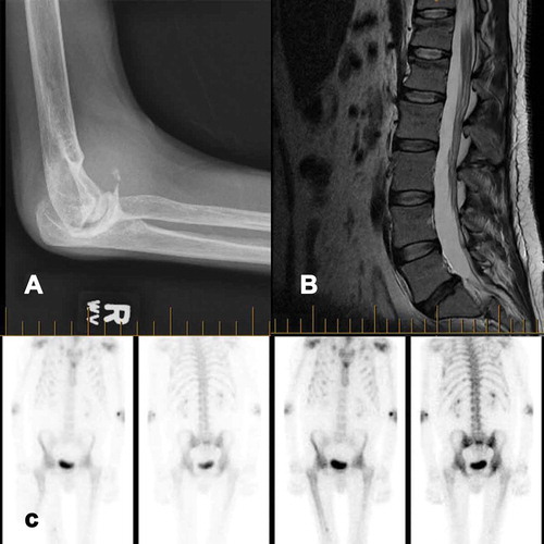 Figure 1. (a) x-ray of right elbow showing significant joint degeneration. (b) MRI of the spine showing superior end plate compression fractures in T12 and L1 with minimal loss of height. (c) Bone scan revealing widespread increased uptake
