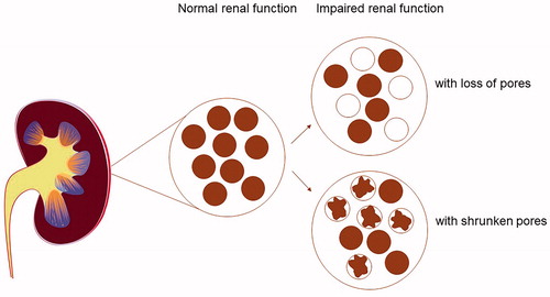 Figure 1. Kidney with normal function and normal glomeruli, and examples of renal glomerular function impairment caused by fewer pores and shrunken pores.