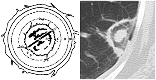 Figure 1. (A) Central zone: needle electrode; (B) partial items related to vaporisation and coagulation necrosis, the phenomenon of ghost (apparently intact tissue); (C) coagulation necrosis at the boundary of the nodule containing cells, an air trapping and a ghost phenomenon; (D) enzymatic necrosis, partial destruction of the blood and lymphatic capillaries, micro thrombosis and lysosomal enzyme activation; (E) Inflammatory reaction and peripheral hyperaemia.