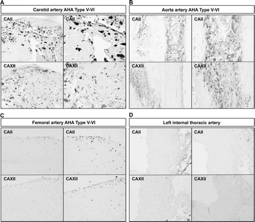 Figure 4. Expression of CAII and CAXII proteins in human atherosclerotic plaques in human aortic (A), femoral (B), and carotid (C) plaques. Samples from internal thoracic artery served as controls (D). Arrows indicate typical positively stained cells. The stage of atherosclerosis was classified according to American Heart Association (AHA) classification (type I–VI). 100× magnification.