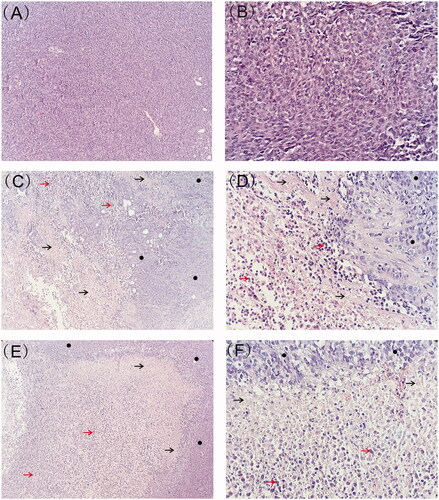 Figure 5. Typical histology images of tumors retrieved on day 7 and day 23 post-implantation (black arrow represents necrotic area, red arrow represents nuclear debris of tumor cells and black circle represents viable tumor cells). (A) Histology image of tumor treated with blank implants (magnification ×100). (B) Histology image of tumor treated with blank implants (magnification ×400). (C) Histology image of tumor treated with high-dose etoposide-loaded implants (drug content 3 mg) on day 7 post implantation (magnification ×100). (D) Histology image of tumor treated with high-dose etoposide-loaded implants (drug content 3 mg) on day 7 post implantation (magnification ×400). (E) Histology image of tumor treated with high-dose etoposide-loaded implants (drug content 3 mg) on day 23 post-implantation (magnification ×100). (F) Histology image of tumor treated with high-dose etoposide-loaded implants (drug content 3 mg) on day 23 post-implantation (magnification ×400).