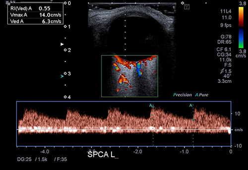 Figure 3 Blood flow spectrum of short posterior ciliary artery in Colour Doppler Imaging.