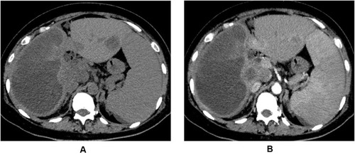 Figure 1 A 43-year-old patient who received transarterial chemoembolization combined with molecular targeted agents plus immune checkpoint inhibitors for hepatocellular carcinoma presented with abdominal pain and fever. The computed tomography plain scan (A) and enhanced scan (B) images of a patient demonstrated obvious liquefactive necrosis within the tumor (the right lobe of the liver). Catheter drainage was performed under the guidance of ultrasound and the bacterial culture result of the liquefactive necrosis content was positive.