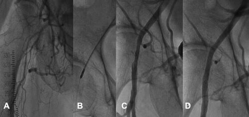 Figure 1 (A). Chronic total occlusion of the right common femoral artery. (B). Jetstream atherectomy (Boston Scientific, Maples Grove, MN, IL). (C). Post Jetstream atherectomy with no adjunctive therapy. (D). Post Drug-coated balloon following Jetstream atherectomy.
