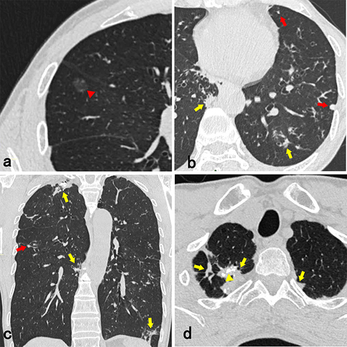 Figure 2 A 63-year-old man with non-neoplastic GGN. An oval pure GGN (red arrowhead) with well-defined boundary is detected in the right middle lobe (a). It cannot be excluded as a neoplastic lesion. On axial and coronal CT images (b-d), multiple solid nodules (red arrows), fibrosis and patchy opacification (yellow arrows) diffusely distribute in both lungs. In the right upper lobe, calcification (yellow arrowhead) can be seen in the patchy opacification, with adjacent pleural thickening and adhesion (d). (GGN, ground-glass nodule).