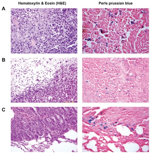 Figure 6 Histological analysis of the uptake of doxorubicin-loaded magnetic Fe3O4 nanoparticles (DOX-MNPs) in tumors (blue indicated the presence of iron): (A) marked accumulation of DOX-MNPs was observed in tumor cells with an external magnetic field; (B) less accumulation of DOX-MNPs in tumor cells without an external magnetic field; (C) accumulation of DOX-MNPs in lung metastasis of Lewis lung carcinoma.