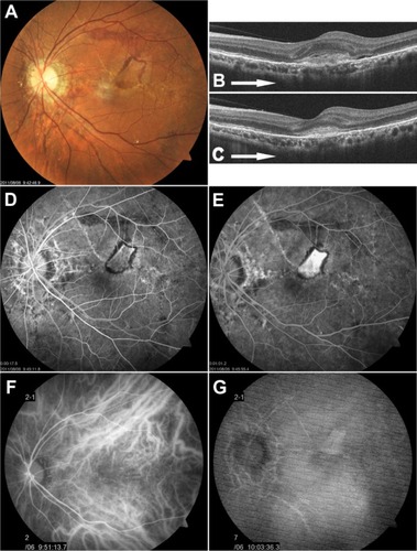 Figure 3 Left fundus findings 3 months after injury.