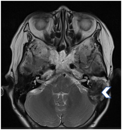 Figure 2. A T2 weighted MRI scan performed prior to the surgery shows high signal intensity in the periphery of the mastoid and middle ear soft tissue lesion (arrow head).