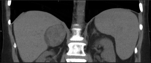 Figure 2. Coronal computed tomography showing a low attenuating right adrenal mass, which proved to be an adrenal collision tumor on pathology.