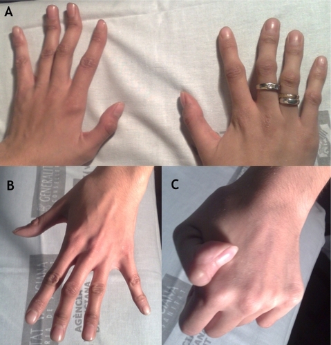 Figure 1 (A–C) Typical contractural aracnodactylia in Beals syndrome (A, B) and joint hypermobility (C).