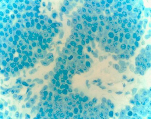 Figure 4.  The lack of Histidine decarboxylase immunoreactivity in the skin specimen infiltrated with plasma cells. Immunohistochemical staining.