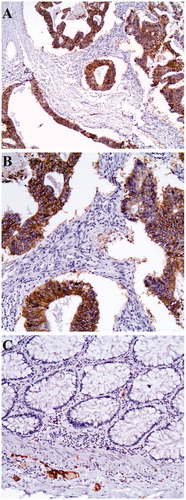 Figure 1. Intense cytoplasmic staining of neoplastic and membranous cells for L1CAM (A) (X100). (B) (X200). (C) Absence of L1CAM staining in normal colonic epithelium. There is L1CAM staining in the ganglionic cells (x200).
