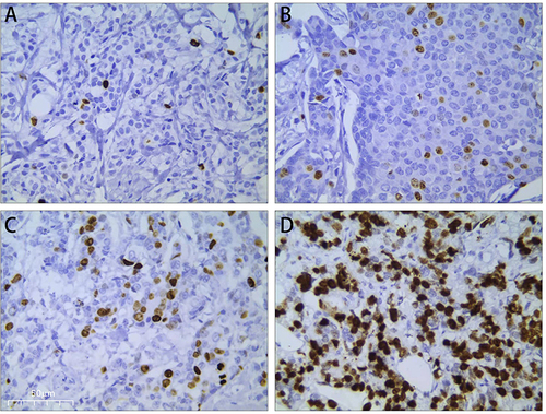 Figure 1 The different expression of Ki-67 in breast cancer of tumor tissues. ((A) 5%; (B) 20%; (C) 30%; (D) 60%; SP x400).