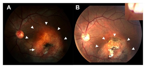 Figure 1 Fundus photograph of the left eye in (A) 2006 and (B) 2012. (A) Fundus photographs showing yellow-white calcified choroidal osteoma (arrowheads) of approximately four disc diameters in size, accompanied by a white decalcified region in the center of the tumor. There are tumor vessels (arrows), designated spider vessels, around the decalcified region. (B) The calcified regions (arrowheads) are obviously smaller and the decalcified region is wider than that observed in 2006.