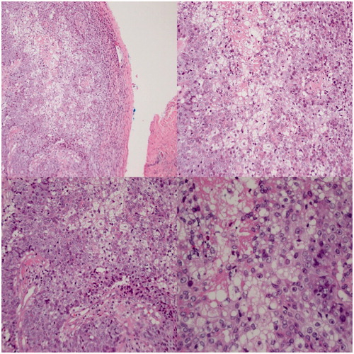 Figure 2. The tumor consists of lobules of basaloid to multivacuolated tumor cells, the latter containing clear vacuoles in the cytoplasm, indicating sebaceous differentiation. Top left: 100x magnification. Bottom left and Top right: 50x magnification. Bottom right: 200x magnification.