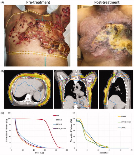 Figure 3. Pre- and post-treatment images and radiation plan for a patient with extensive triple negative breast cancer recurrence treated with hyperthermia and IMRT. (A). Pretreatment (left) and 1 month post-treatment (right) images of a patient with recurrent cancer involving bilateral chest wall and left arm. (B) Radiation dose distributions on axial (left), coronal (middle), and sagittal (right) images for the patient. The PTV is shaded in yellow and treated to 32 Gy. Isodose lines are shown: 35.2 Gy (red), 32.0 Gy (green), 28.8 Gy (purple), 22.4 Gy (orange), 16.0 Gy (blue). (C) Dose volume histogram (DVH) for the PTV, lung, heart, spinal cord and liver are shown.