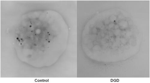Figure 11. Transmission electron microscopy images of whole platelets in whole mount preparations of control and δ-granule deficient (DGD) samples. The image from the control platelet (left) shows numerous electron dense structures and the majority of these structures have smooth contours and a uniform electron density, which is typical of δ-granules. The platelet from the δ-granule deficient subject contains only one electron dense granule, consistent with their low δ-granule count and confirmed δ-granule deficiency.