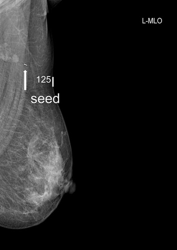 Figure 1 Post 125I seed implantation mammograms. The 125I seed was implanted inside the axillary lymph node successfully. Arrow: the implanted 125I seed.