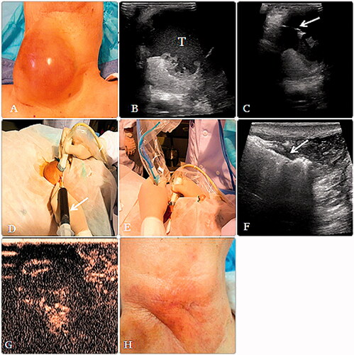 Figure 1. (A, B) A 79-year-old man had a thyroid papillary carcinomas’ postoperative metastasis to the cervical lymph nodes, before MWA, a huge mass could be seen in the neck, and the lesion (T) consisted of cystic and solid parts. (C, D) Aspirating the fluid in the lesion with a fine needle (arrow), the dark red fluid (arrow) aspirated from the lesion during operation. (E) After aspiration, an microwave atenna was placed in the lesion to ablate the solid portion. (F) During the MWA procedure, multiple echogenic microbubbles (arrow) around the antenna tip were noted. (G) After MWA, CEUS showed that most of the lesion was inactivated and showed no enhancement. (H) Six months after MWA, the lesion almost could not be seen and only a scar and some pigmentation were left on the neck.