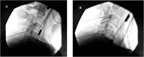 Figure 1 X-ray (lateral view) images illustrating the cannula and probe positions during the CRFA procedure: (A) at C4 medial branch and (B) at C3 and C5 medial branches.