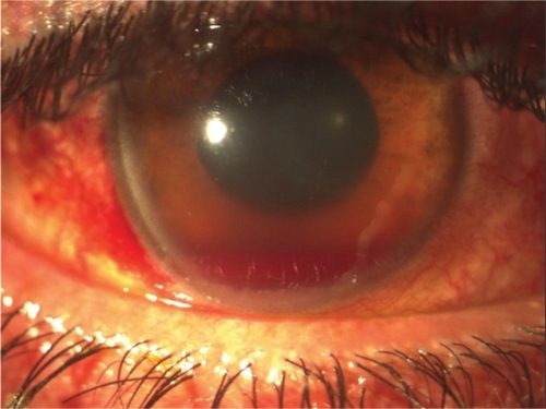 Figure 1 Patient with a moderate hyphema, iridoplegia, laceration of the pupillary sphincter at 9 o’clock and conjuctival hemorrhage at the site of globe injury.