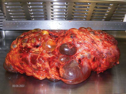 Figure 1.  Nephrectomy specimen of the left polycystic kidney (axial length: approximately 38 cm; weight 6.820 kg).