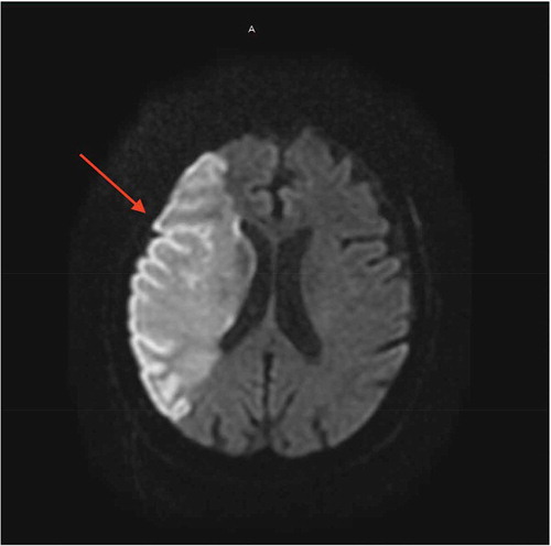 Figure 2. MRI brain with and without IV contrast on day 1